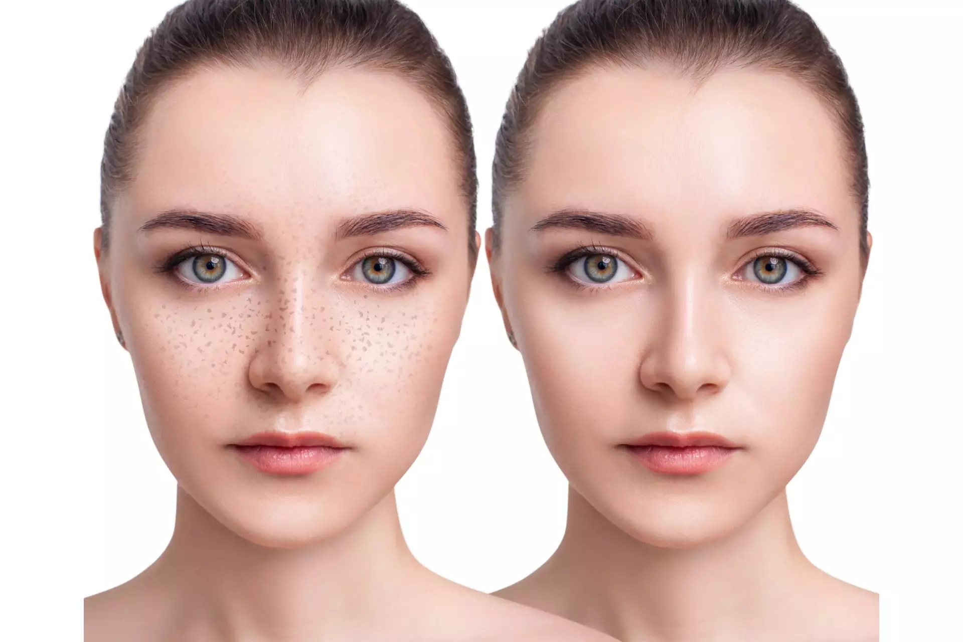 Hyperpigmented spots